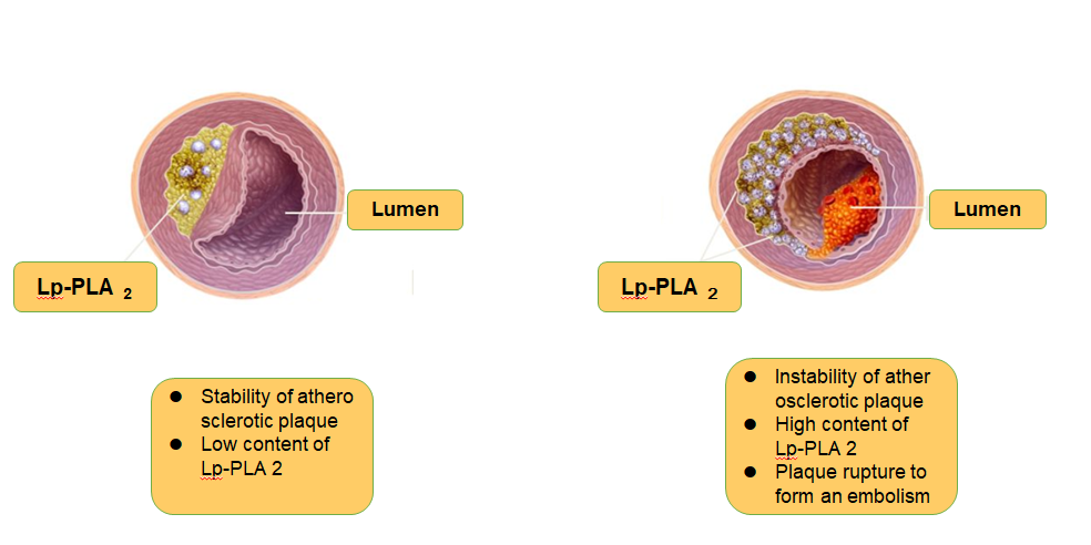 Schematic diagram of Lp-PLA2 and plaque stability 1.png